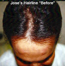 Hair Transplant before after photos