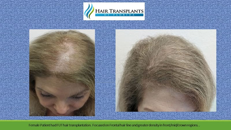 Best Hair Transplant Altamonte Springs, FL - Hair Growth Treatment